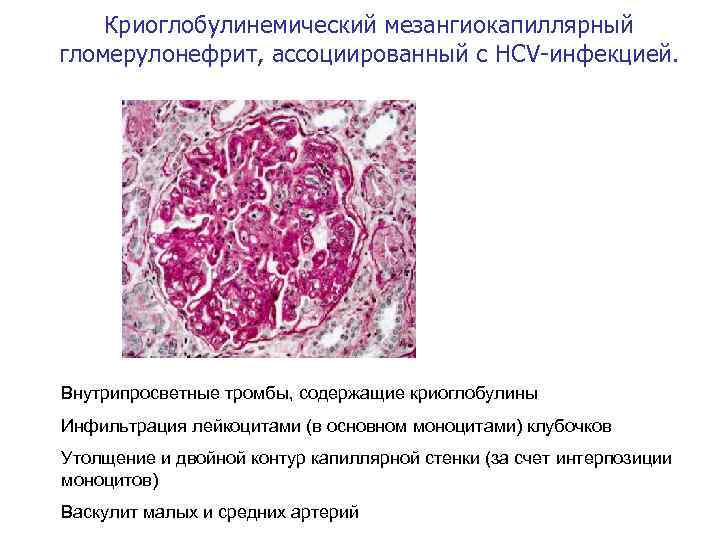 Криоглобулинемический мезангиокапиллярный гломерулонефрит, ассоциированный с HCV-инфекцией. • Внутрипросветные тромбы, содержащие криоглобулины • Инфильтрация лейкоцитами