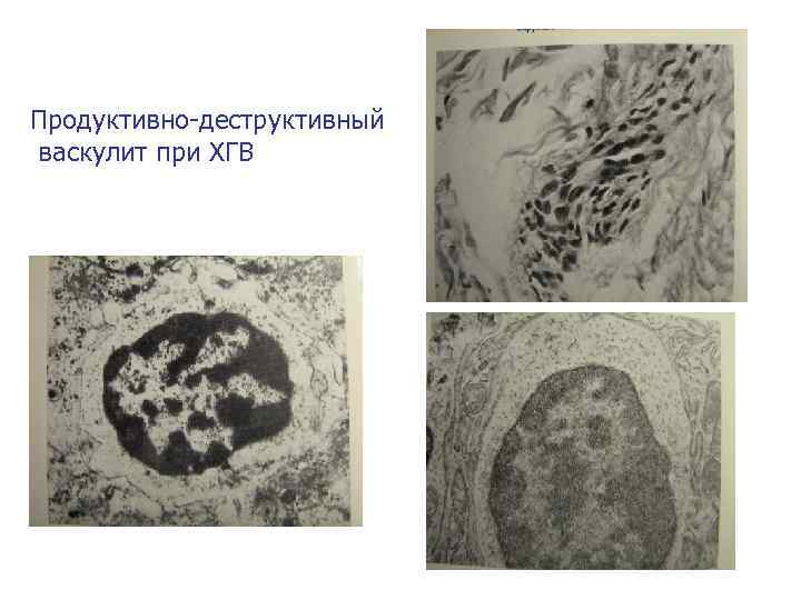 Продуктивно-деструктивный васкулит при ХГВ 