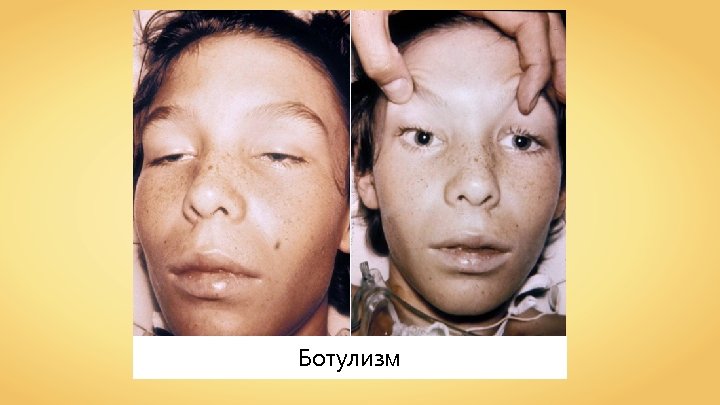 Ботулизм 