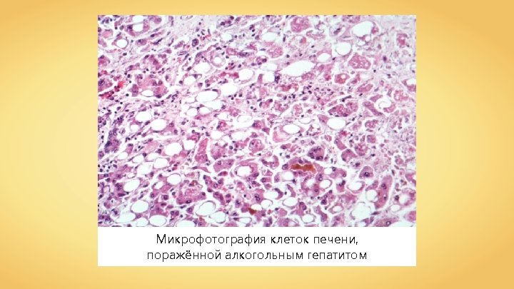 Микрофотография клеток печени, поражённой алкогольным гепатитом 