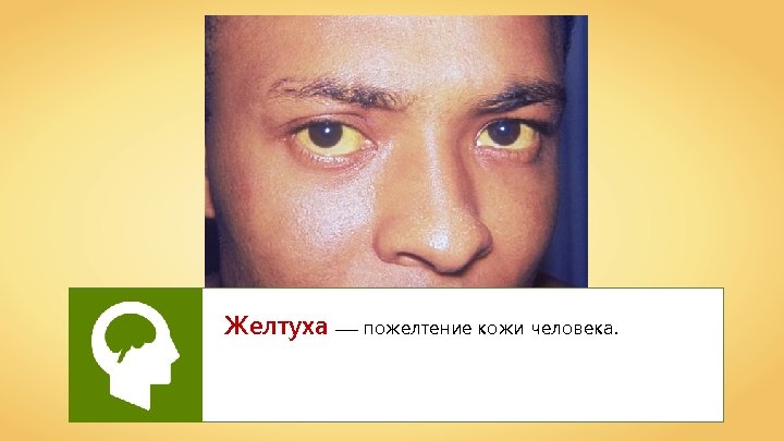 Желтуха —– пожелтение кожи человека. 