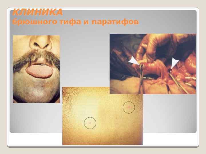 КЛИНИКА брюшного тифа и паратифов 