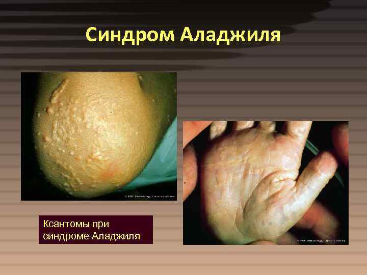 Синдром Аладжиля Ксантомы при синдроме Аладжиля 
