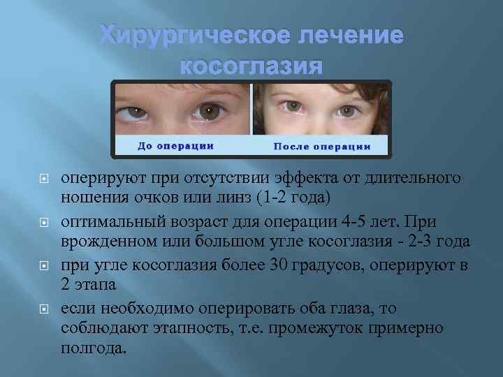 Операция на глаза от косоглазия. Угол косоглазия. Операция по исправлению косоглазия. Выявление косоглазия.