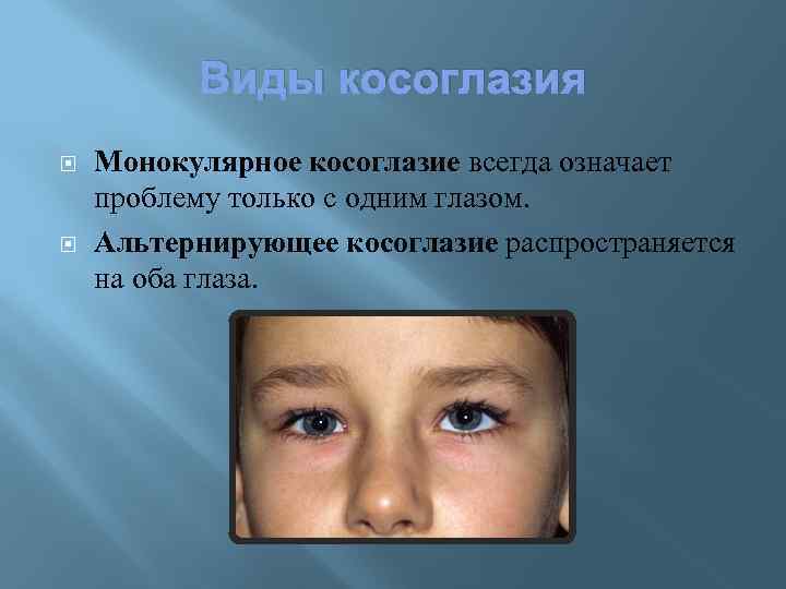 Виды косоглазия Монокулярное косоглазие всегда означает проблему только с одним глазом. Альтернирующее косоглазие распространяется