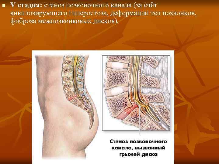 n V стадия: стеноз позвоночного канала (за счёт анкилозирующего гиперостоза, деформации тел позвонков, фиброза