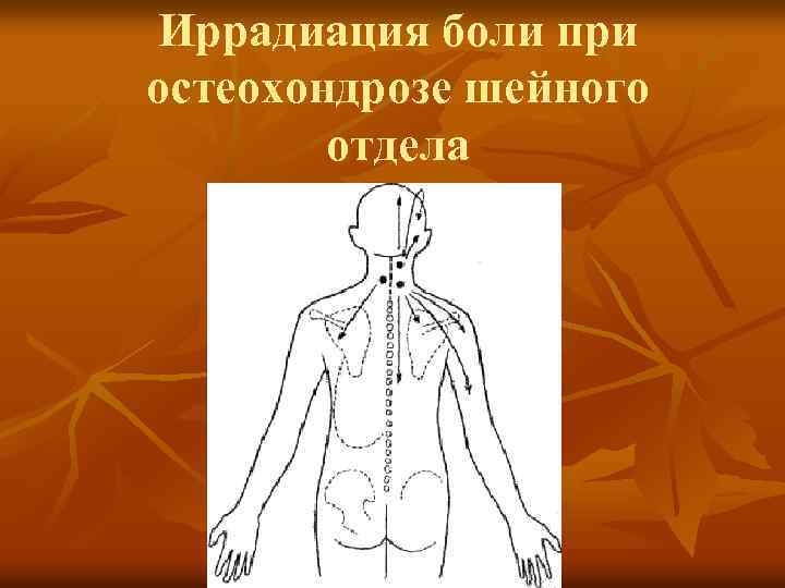 Иррадиация боли при остеохондрозе шейного отдела 