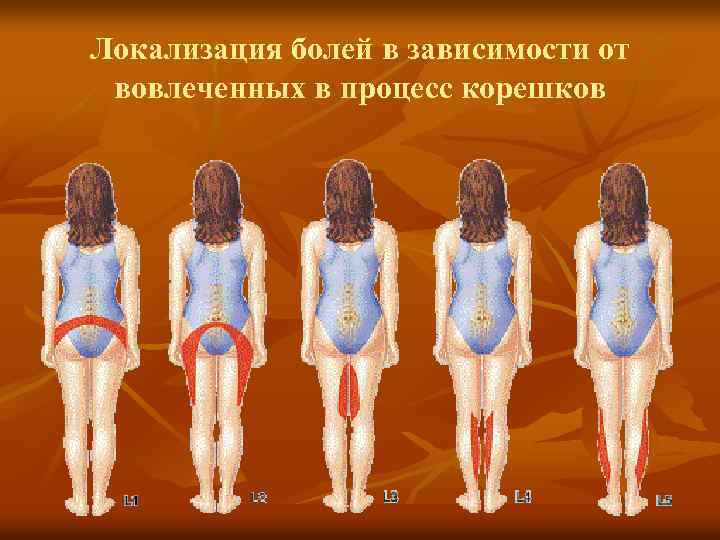 Локализация болей в зависимости от вовлеченных в процесс корешков 