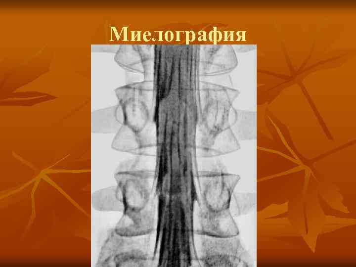 Миелография 