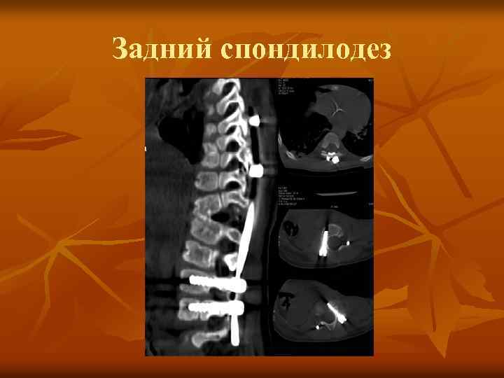 Задний спондилодез 