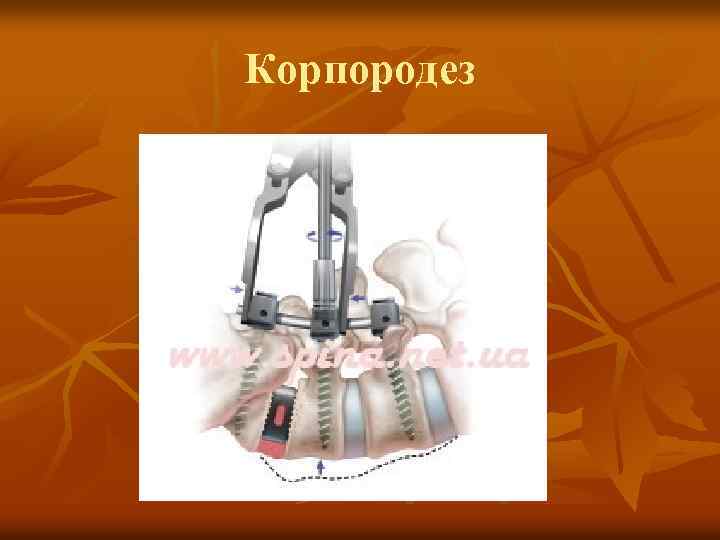 Корпородез 