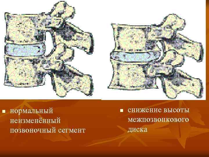 n нормальный неизменённый позвоночный сегмент n снижение высоты межпозвонкового диска 