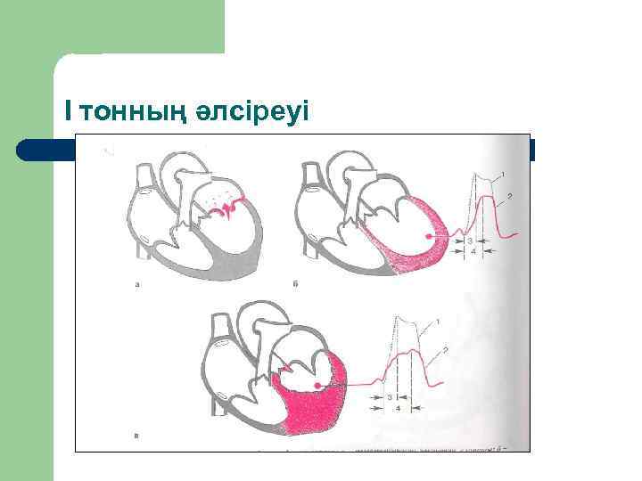 І тонның әлсіреуі 