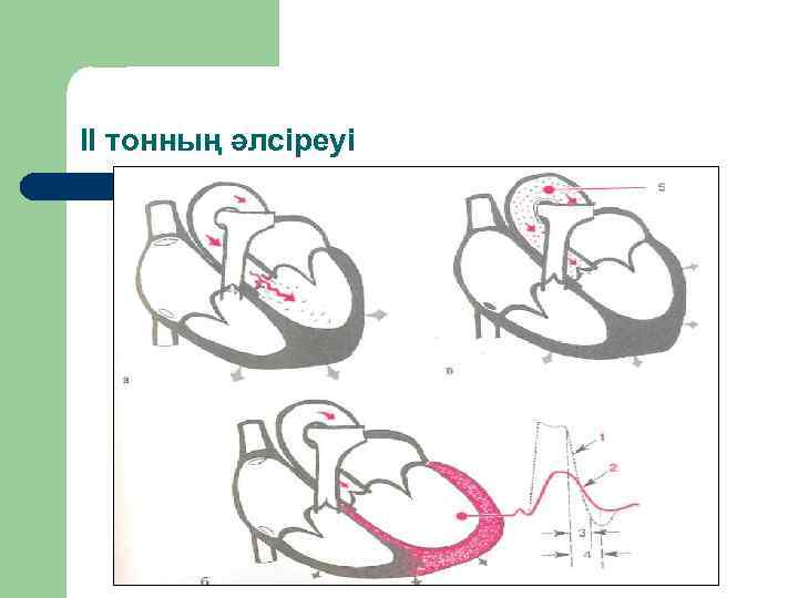 ІІ тонның әлсіреуі 