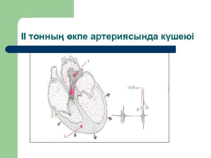 ІІ тонның өкпе артериясында күшеюі 