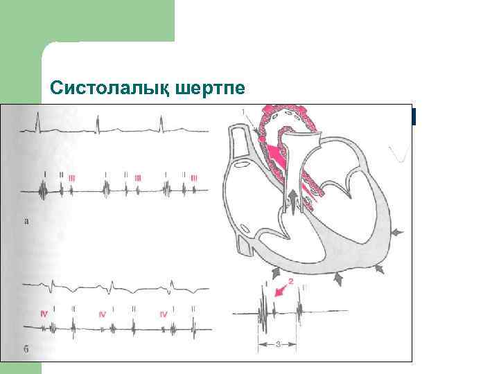 Систолалық шертпе 