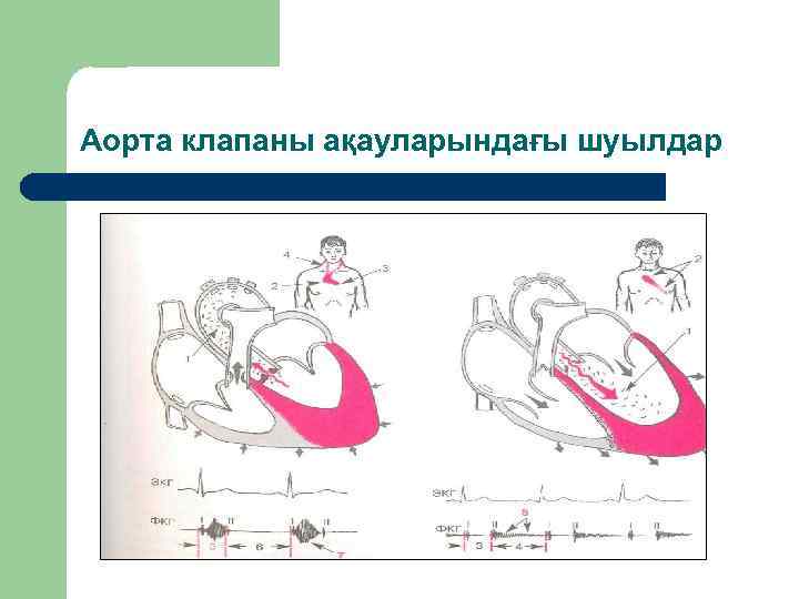 Аорта клапаны ақауларындағы шуылдар 