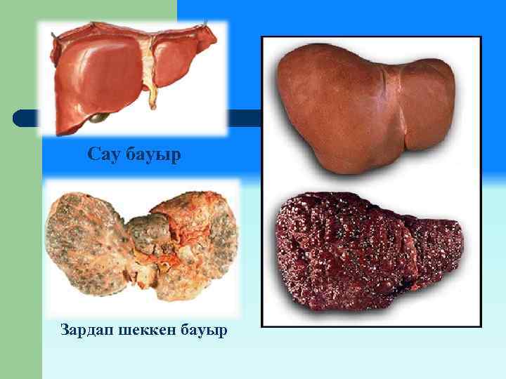 Сау бауыр Зардап шеккен бауыр 