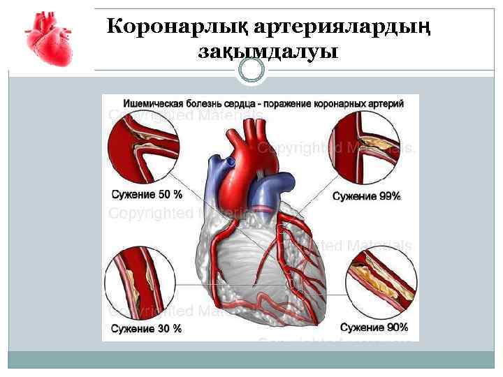 Коронарлық артериялардың зақымдалуы 