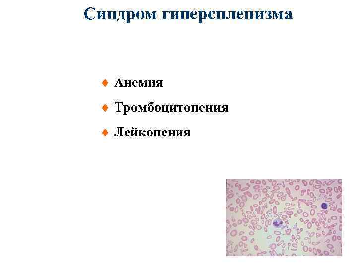 Лейкопения при анемии. Экхимозы тромбоцитопения анемия. Лейкопения тромбоцитопения причины. Анемия лейкопения тромбоцитопения одновременно. Тромбоцитопения и анемия причины.