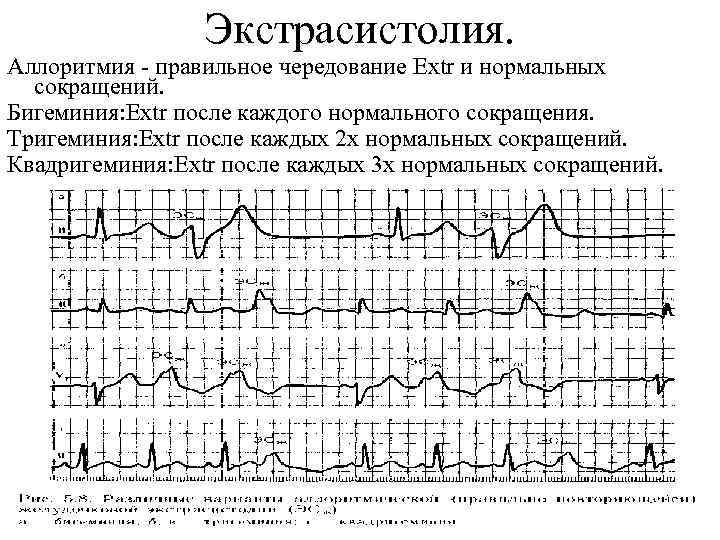 Экстрасистолия. Аллоритмия - правильное чередование Extr и нормальных сокращений. Бигеминия: Extr после каждого нормального