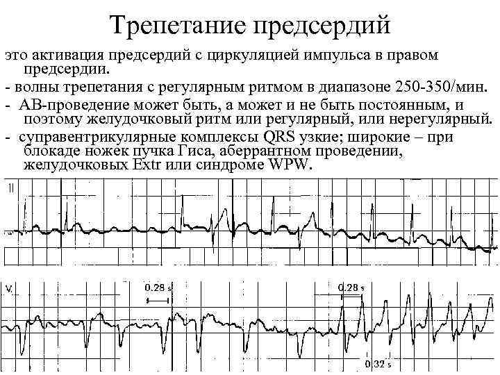 Фибрилляции предсердий карта вызова