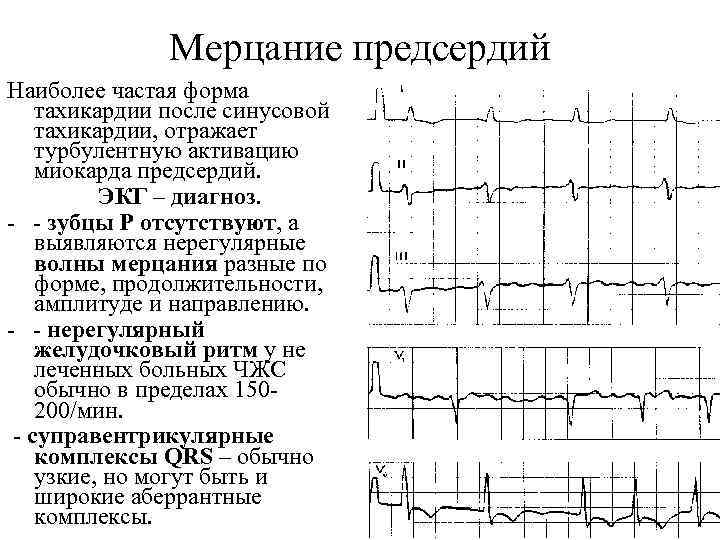 Мерцание предсердий Наиболее частая форма тахикардии после синусовой тахикардии, отражает турбулентную активацию миокарда предсердий.