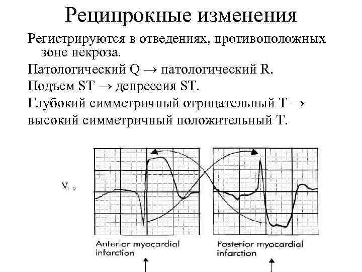 Изменения в миокарде при инфаркте миокарда