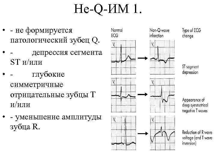 Не-Q-ИМ 1. • - не формируется патологический зубец Q. • - депрессия сегмента ST