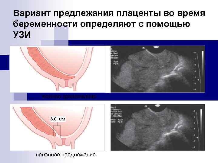 Вариант предлежания плаценты во время беременности определяют с помощью УЗИ полное предлежание неполное предлежание