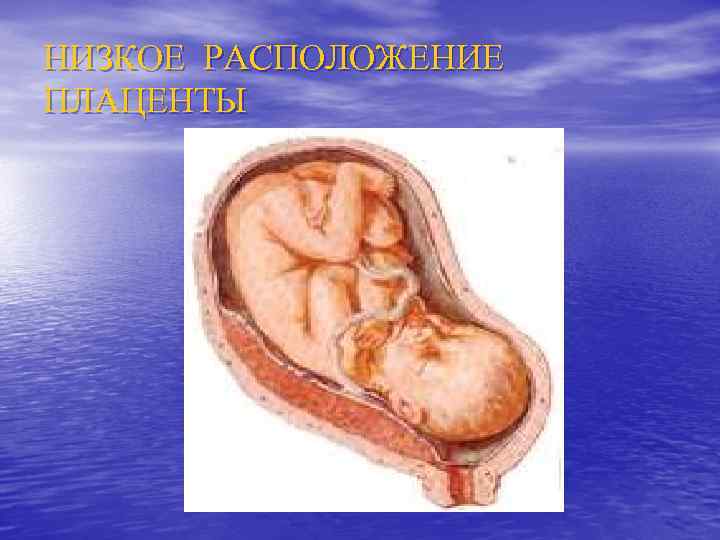 НИЗКОЕ РАСПОЛОЖЕНИЕ ПЛАЦЕНТЫ 