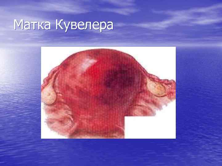 Матка Кувелера 