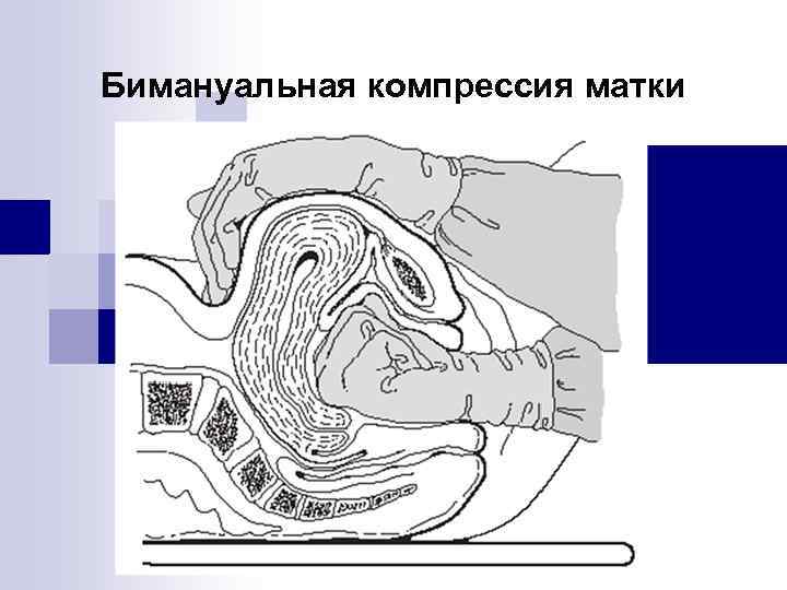 Бимануальная компрессия матки 