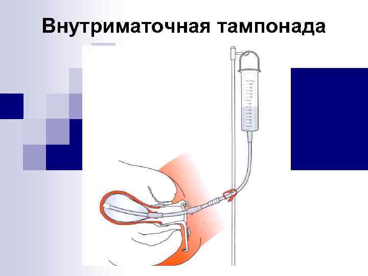 Внутриматочная тампонада 