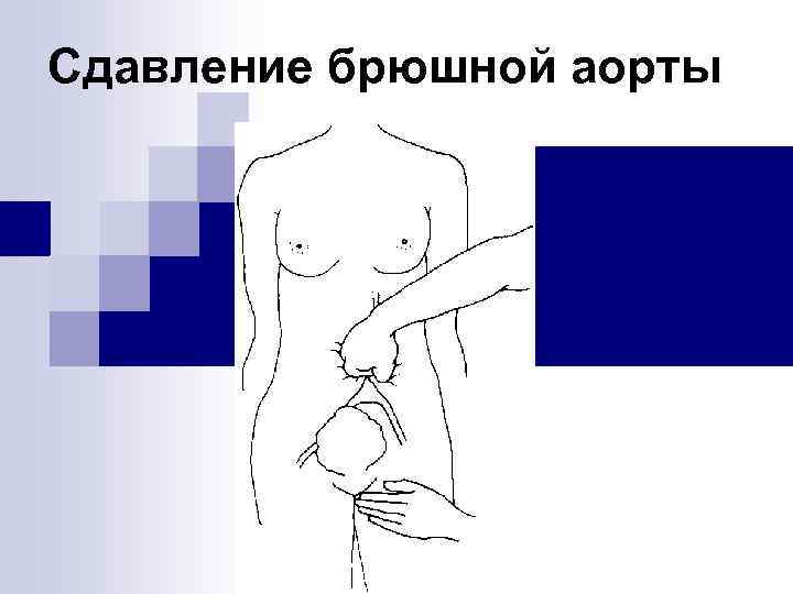 Сдавление брюшной аорты 