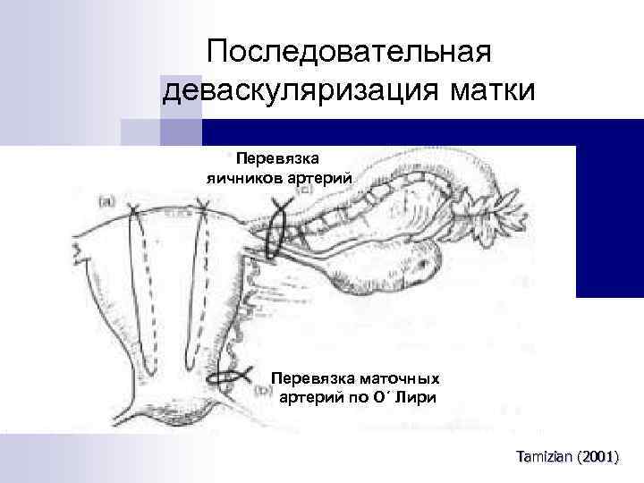 Перевязка маточных труб