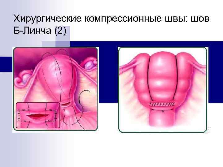 Хирургические компрессионные швы: шов Б-Линча (2) 