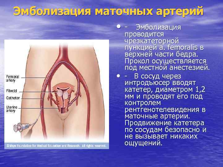 Эмболизация маточных артерий • - • Эмболизация проводится чрезкатеторной пункцией a. femoralis в верхней