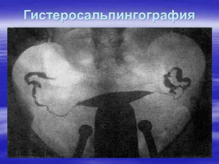 Гистеросальпингография 