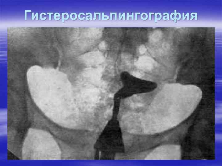 Гистеросальпингография 