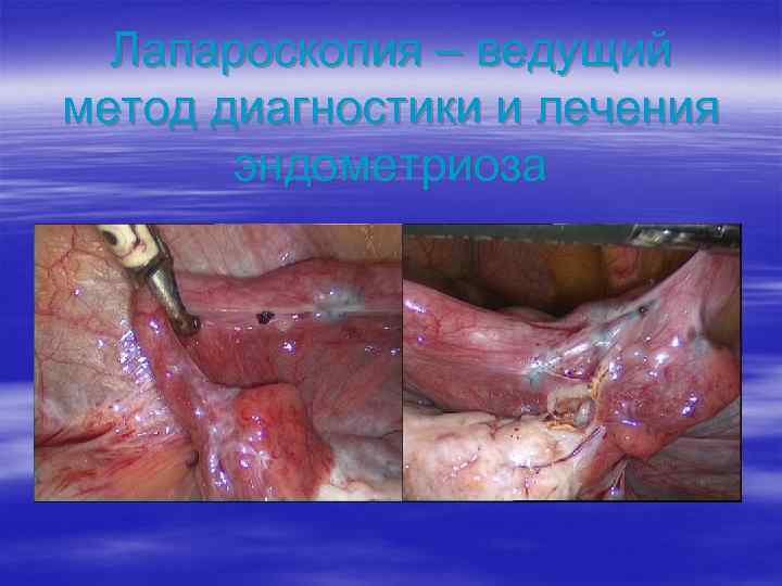 Лапароскопия – ведущий метод диагностики и лечения эндометриоза 