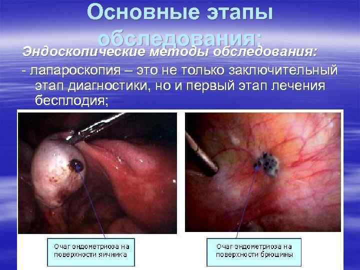 Основные этапы обследования: Эндоскопические методы обследования: - лапароскопия – это не только заключительный этап