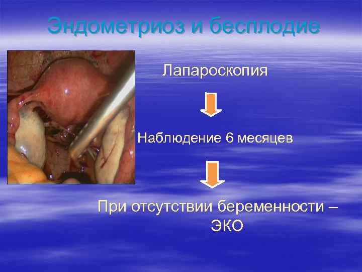 Эндометриоз и бесплодие Лапароскопия Наблюдение 6 месяцев При отсутствии беременности – ЭКО 