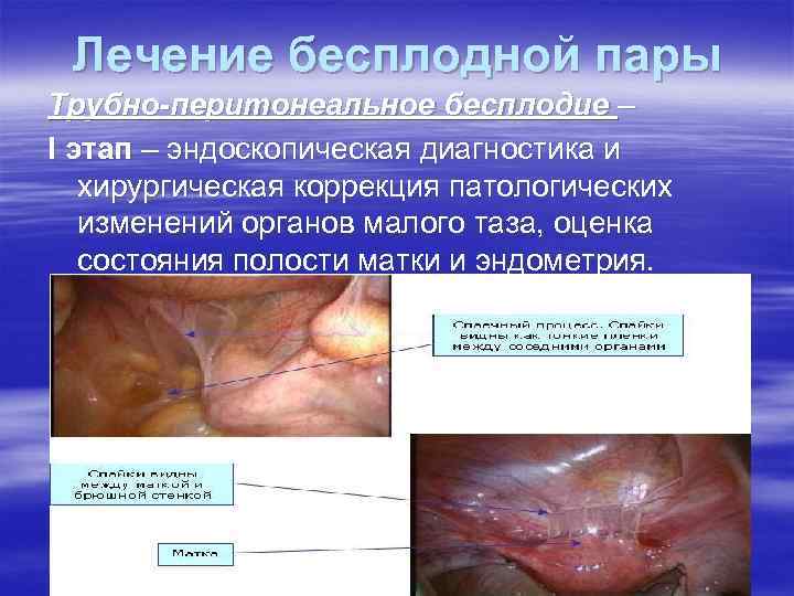 Лечение бесплодной пары Трубно-перитонеальное бесплодие – I этап – эндоскопическая диагностика и хирургическая коррекция