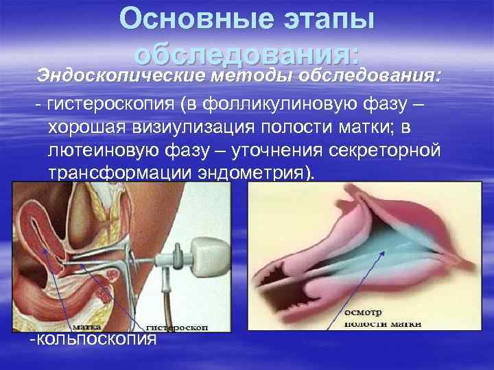 Основные этапы обследования: Эндоскопические методы обследования: - гистероскопия (в фолликулиновую фазу – хорошая визиулизация