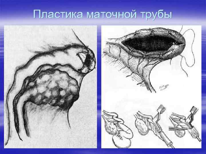 Пластика маточной трубы 