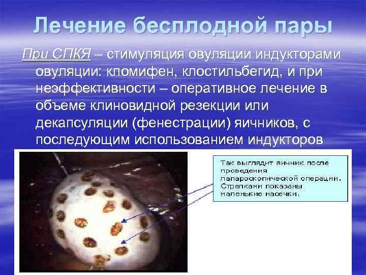 Лечение бесплодной пары При СПКЯ – стимуляция овуляции индукторами овуляции: кломифен, клостильбегид, и при