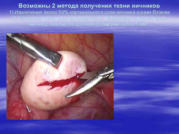 Возможны 2 метода получения ткани яичников 1) Извлечение около 50% кортикального слоя яичника одним