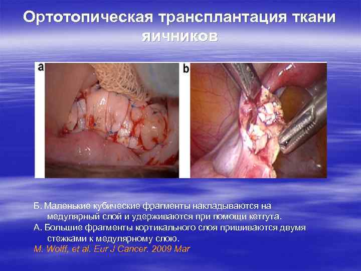 Ортотопическая трансплантация ткани яичников Б. Маленькие кубические фрагменты накладываются на медулярный слой и удерживаются