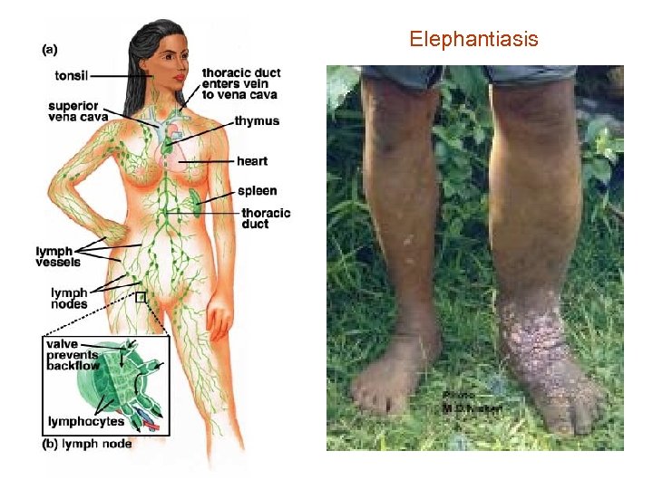 Elephantiasis 